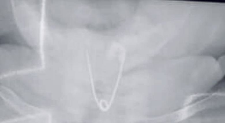 احرصوا على أبنائكم.. فريق طبّي كربلائي ينقذّ طفلاً رضيعاً ابتلعَ (دبوّساً حديدياً)